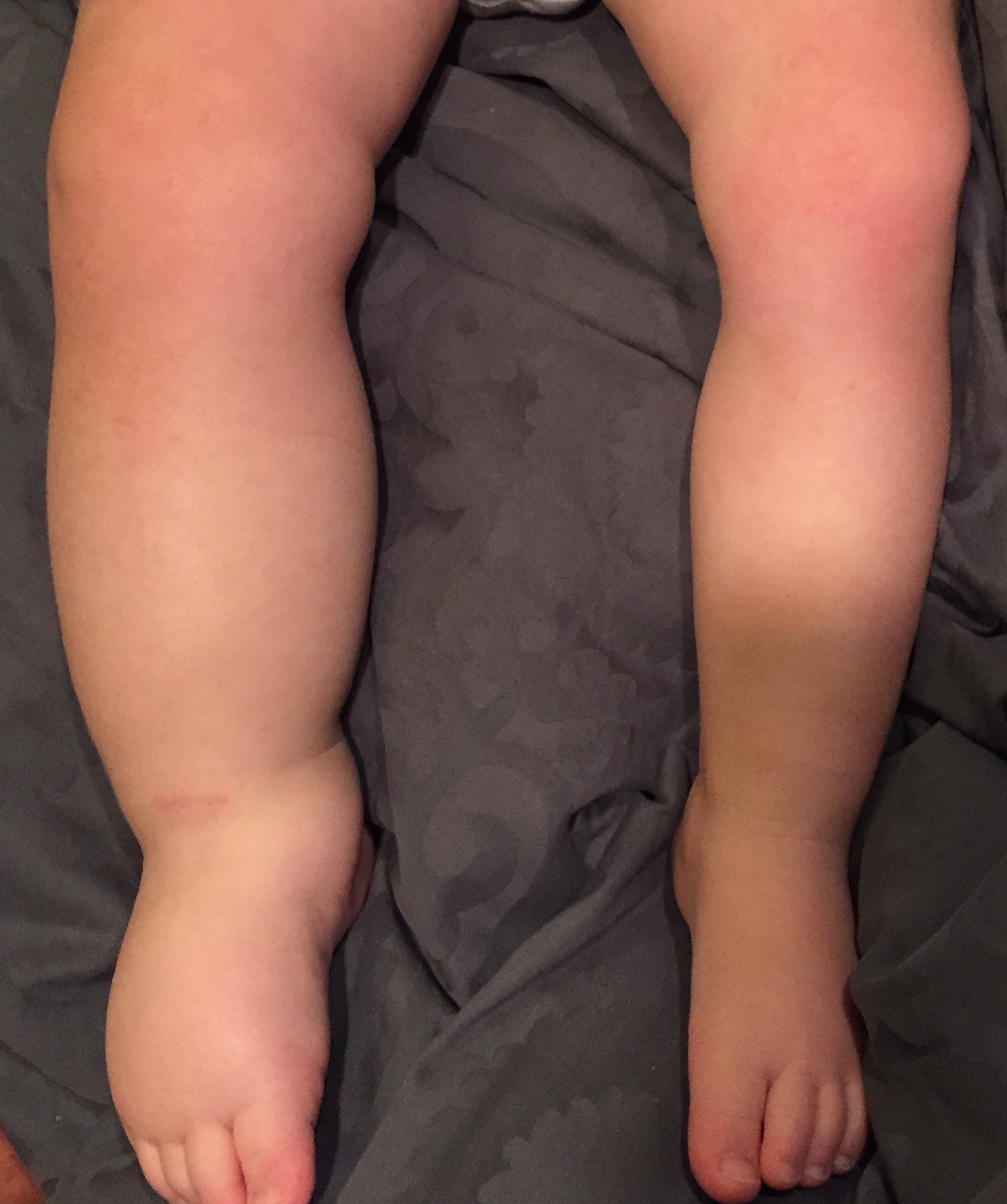 Brylan's feet/legs, 13 months old (first diagnosed)
