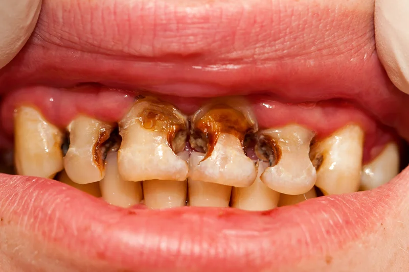Stained cavity filled teeth are shown.