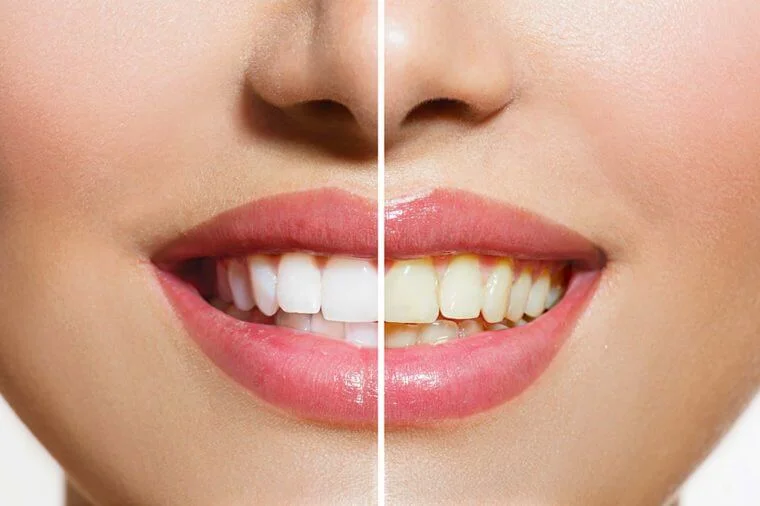 Myths (and Truth) of Whitening Your Teeth