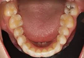 An open mouth with teeth in the lower jaw is shown.