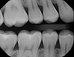 An x-ray of teeth is shown.