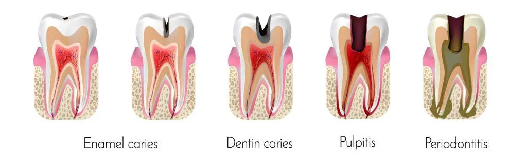 3 Commonly Confused Dental Terms — Alexandria Smiles