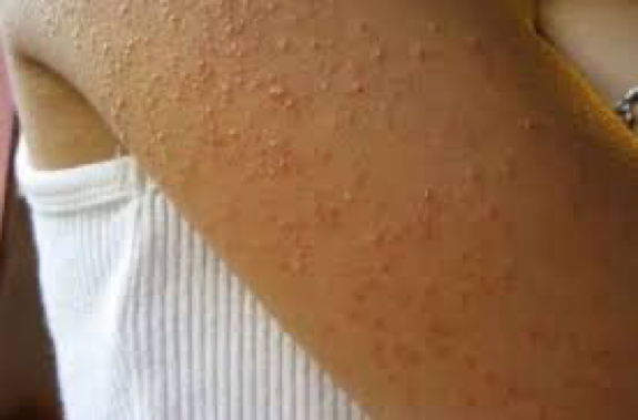 keratosis pilaris lactic acid the ordinary
