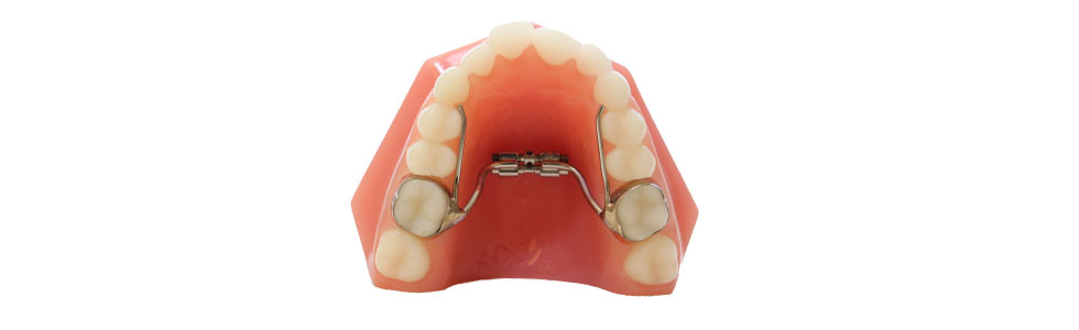 palatal-expander.jpg