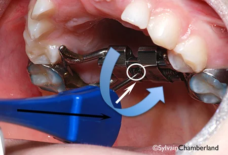 2-comment-activer-appareil-dexpansion-etape-2-orthodontiste-chamberland-quebec.jpg