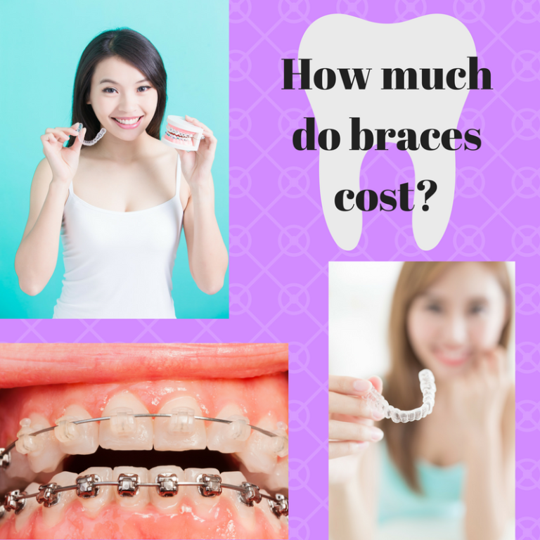 How Much do Braces Cost? — Mashouf Orthodontics