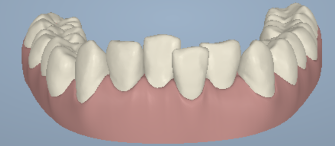 lower-front-teeth-crowding-01a.png