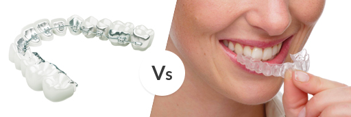 Lingual Braces Vs. Invisalign® – which one is right for me