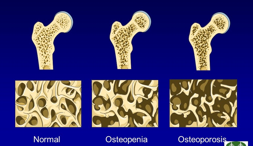 Osteopenia Once Upon A Marathon osteopenia-once-upon-a-marathon