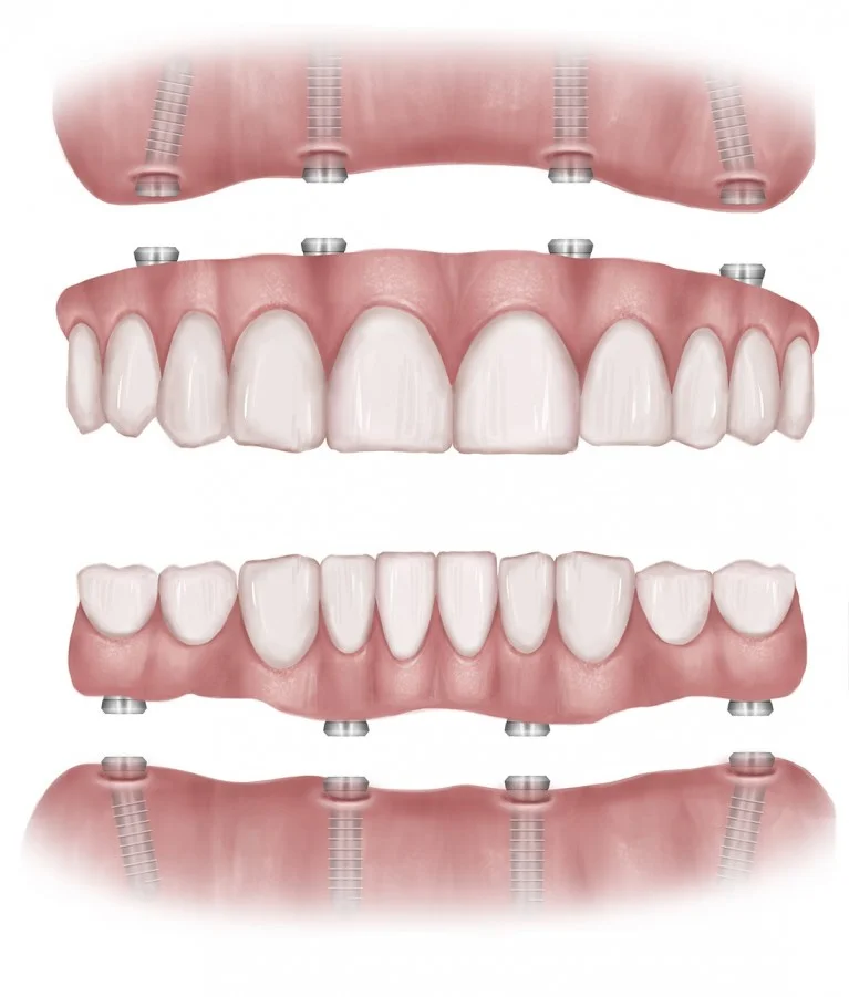 all-on-4-dental-implants-kent.jpg