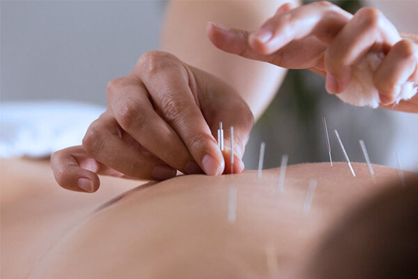 Acupuncture &amp; Dry Needling