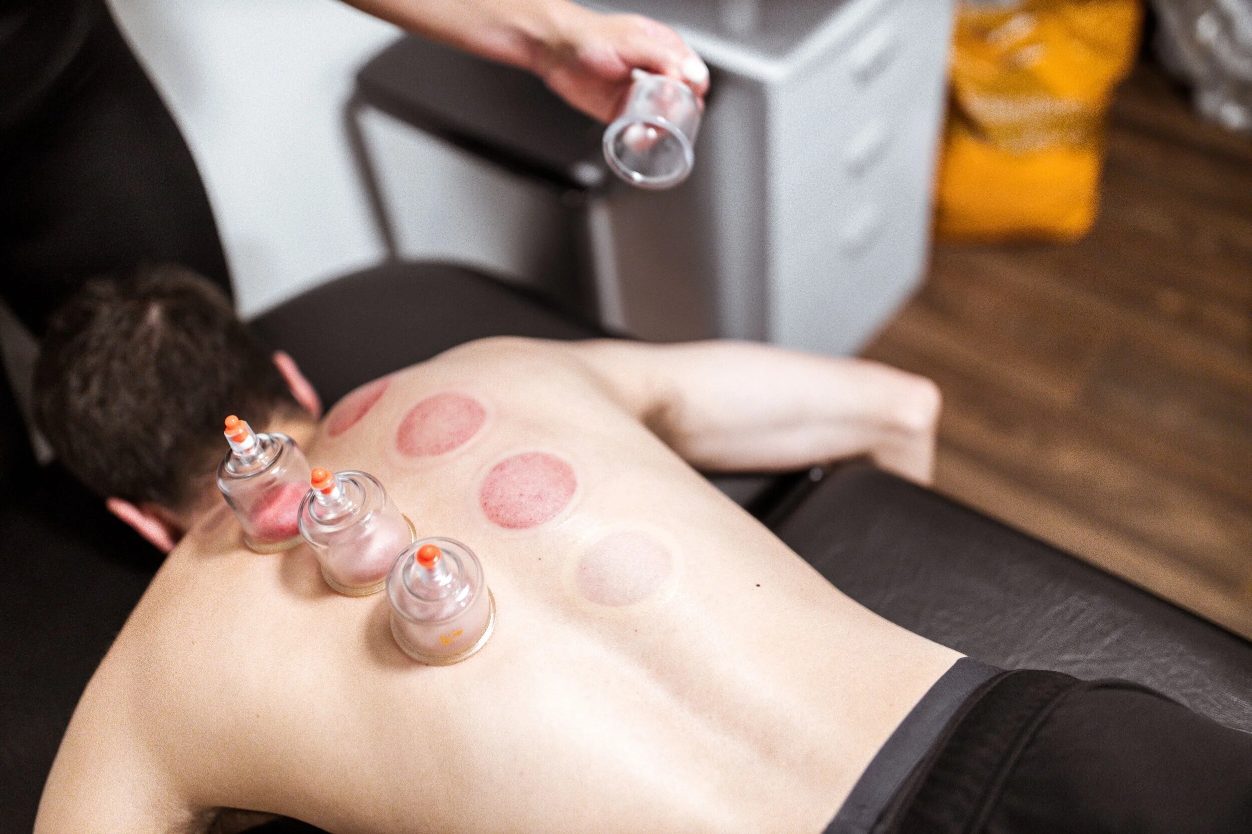 Cupping