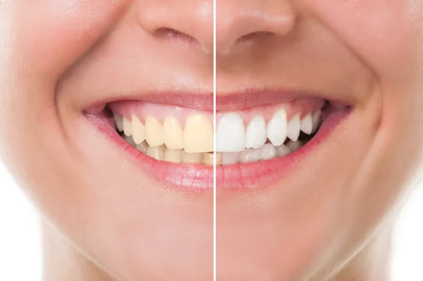 teeth_whitening.jpg