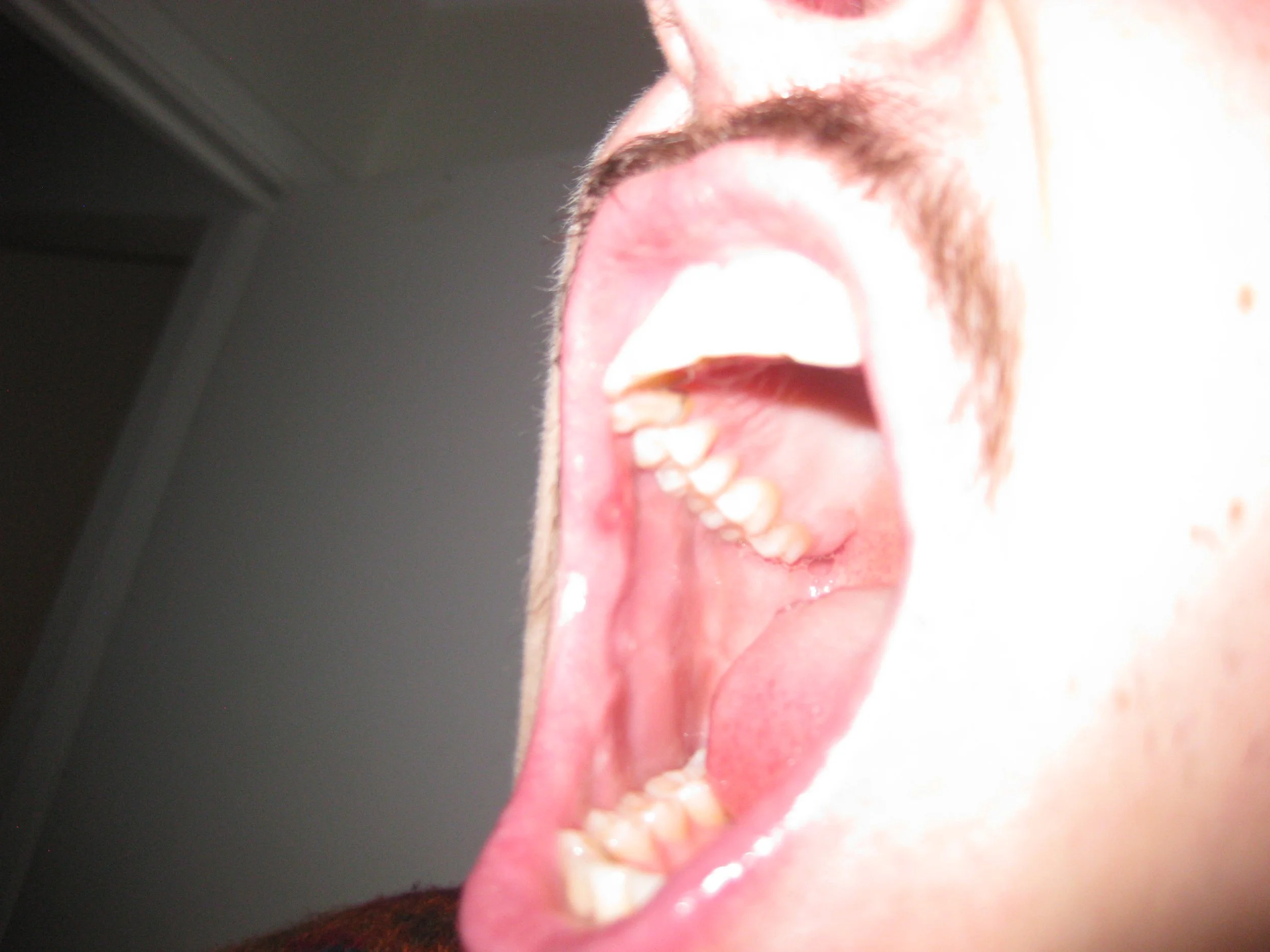My mouth is an open wound