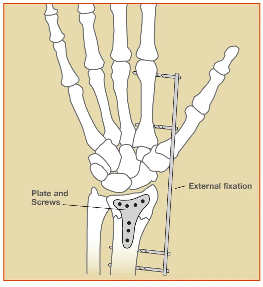 WristFracture_Fig2.jpg