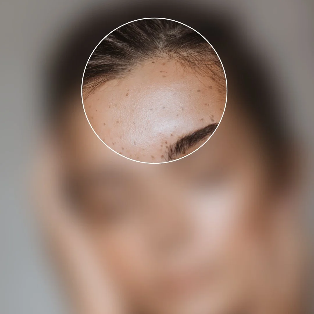 Estetické možnosti pre oblasť čela