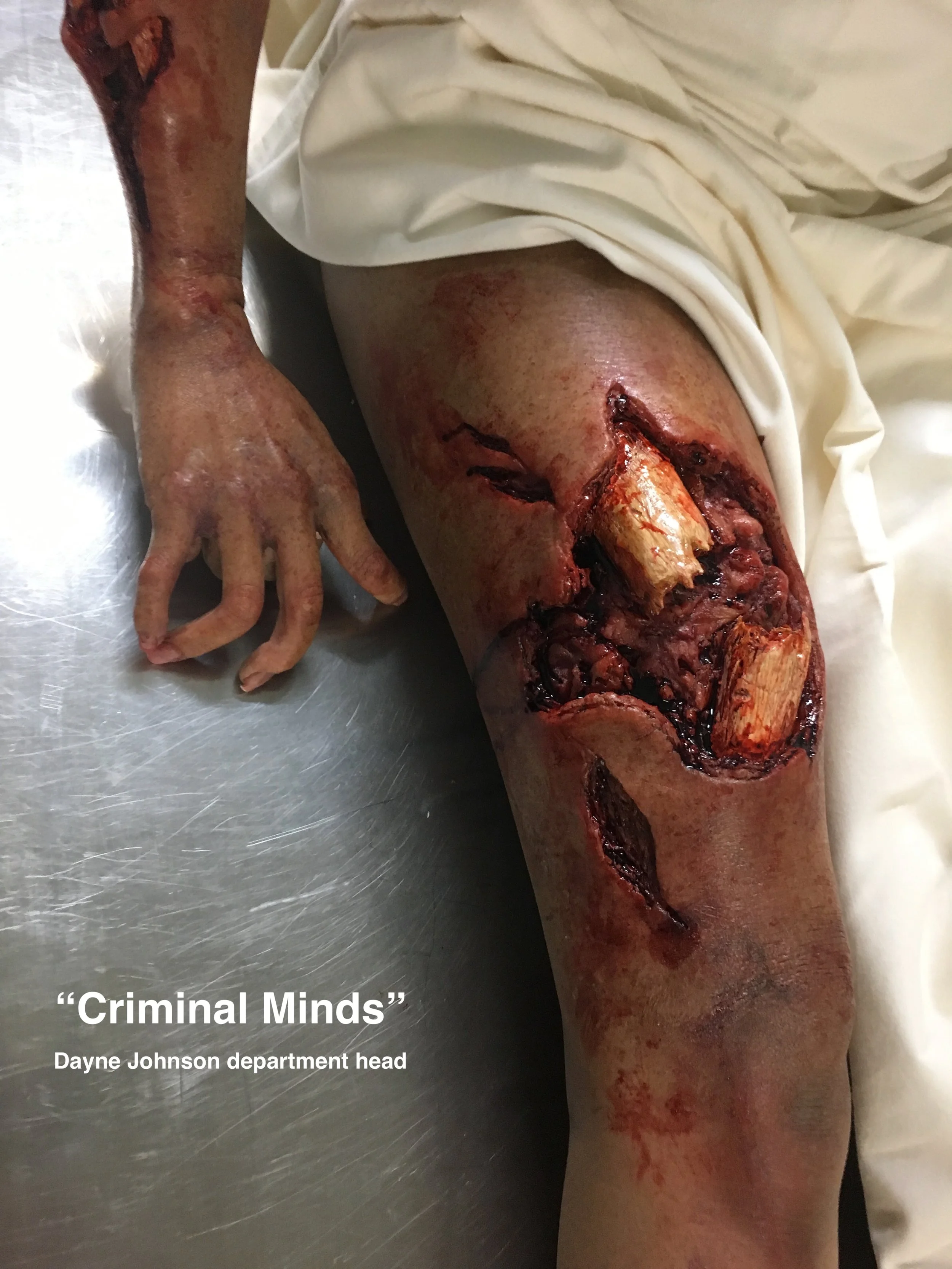 FUSIONFX-Criminal-Minds-broken-femur.jpg