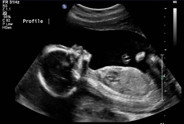 ultrasound .jpg