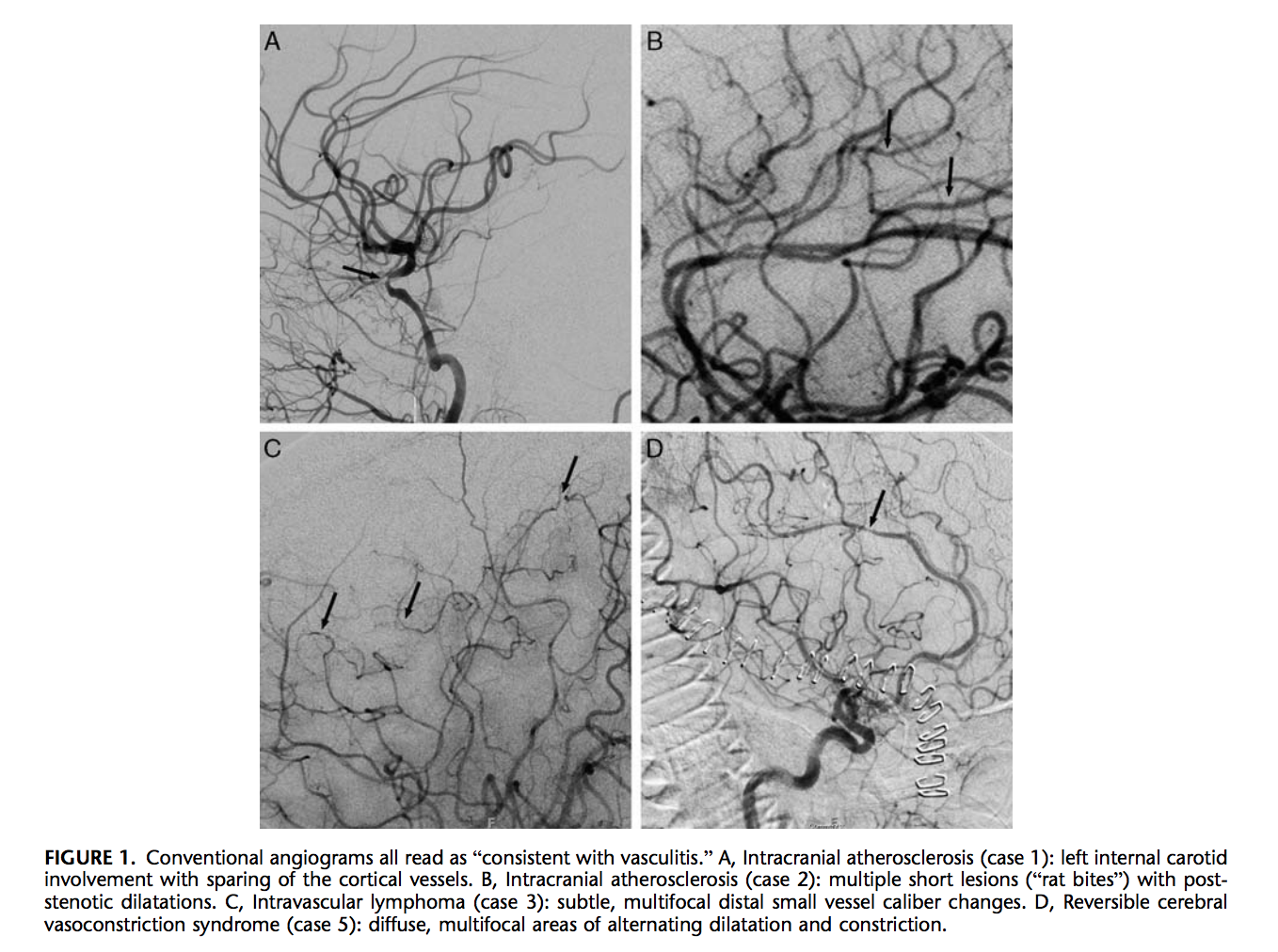 Marsh2012_vasculitis.png