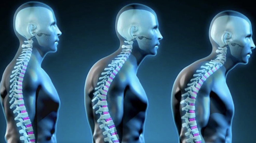 Effective exercises to fix rounded shoulders