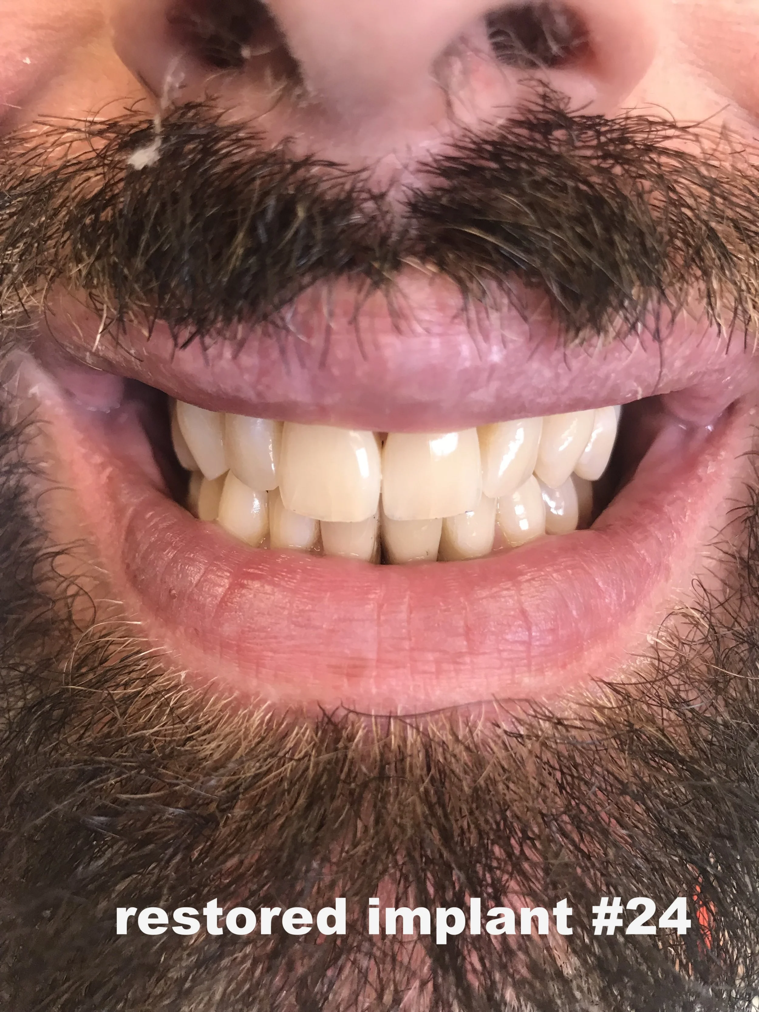 implant #24.jpeg
