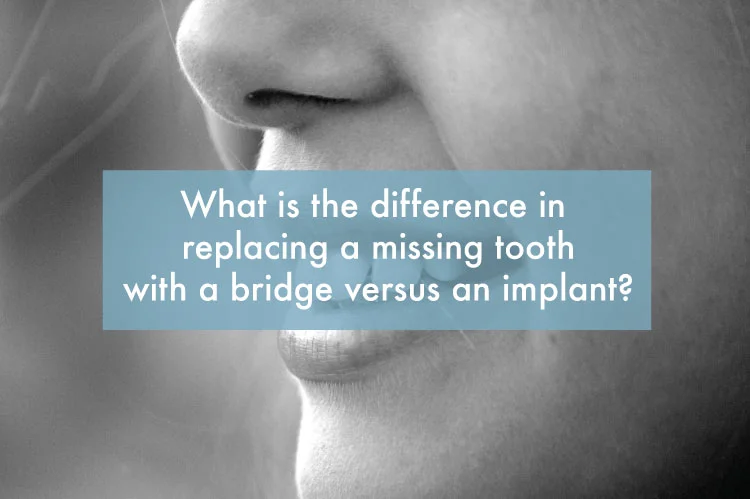 What is the difference in replacing a missing tooth with a bridge versus an implant?