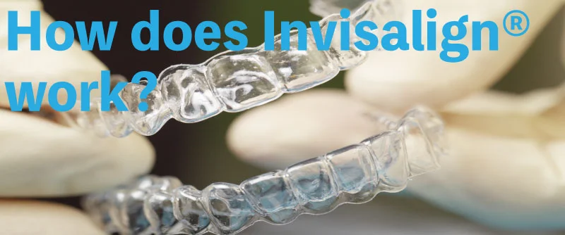 How does Invisalign® work?