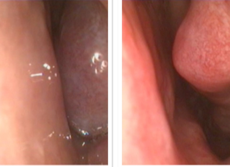 Figure 2 The image on the left shows a swollen inferior turbinate (a normal anatomical structure) causing complete nasal obstruction. The image on the right shows the same nose 5 minutes after application of a nasal decongestant, showing a dramatic reduction in size of the turbinate, and an improvement in the nasal airway. Many treatments for blocked nose aim for this effect. Allergy sprays, (such as Nasonex, Avamys and Omnaris) will give a similar result in some allergic patients, and may be the only treatment that is required. If turbinates remain swollen, and obstructing despite maximal non-surgical treatment, surgery to reduce the turbinates ( coblation of inferior turbinates , or inferior turbinoplasty ) is likely to help.