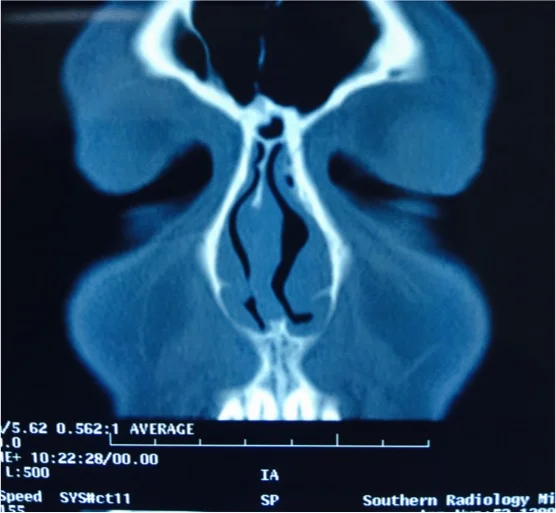 Figure 2: A coronal CT scan which shows a significant bend of the nasal septum to the right with a reduction in the nasal airway.
