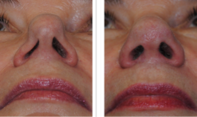 Figure 5: A nose with severe sidewall collapse, requiring external rhinoseptoplasty with Dr Smith, gaining a major improvement in breathing and appearance