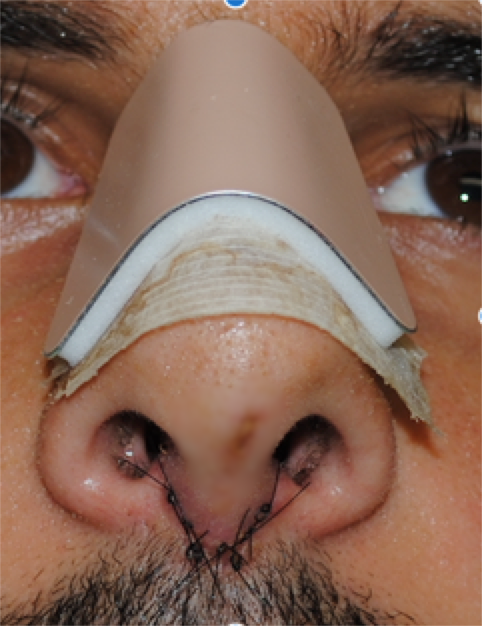 Photo, showing External splint, and stitches