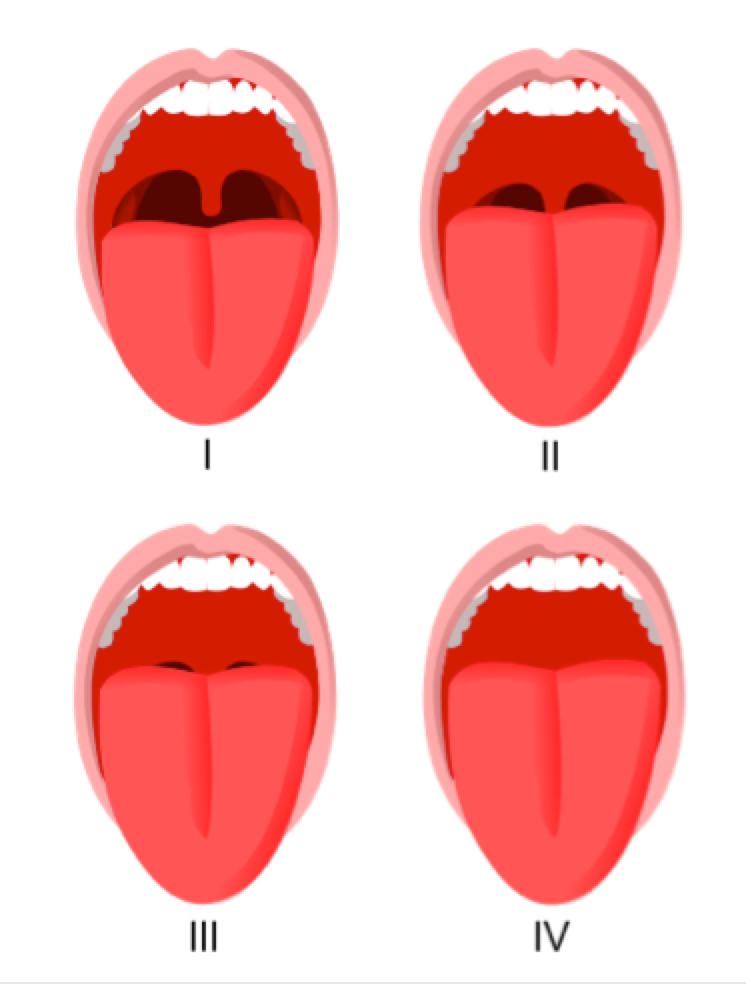 Figure 3: The Mallampati score. The higher score, the more space the tongue takes up in the mouth and throat, and the more likely the patient is to snore. This is a common factor in adult snoring.(Images by Jmarchn - Own work, CC BY-SA 3.0, https://commons.wikimedia.org/w/index.php?curid=12842847)