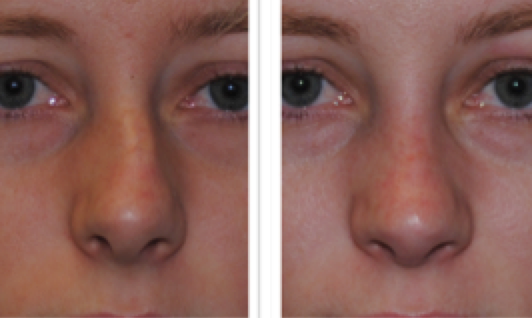 Figure 4: a signicant nasal deviation like this (before and after Rhinoplasty surgery by Dr Smith) is always associated with septal deviation, which in turn is likely to be associated with snoring and poor sleep quality