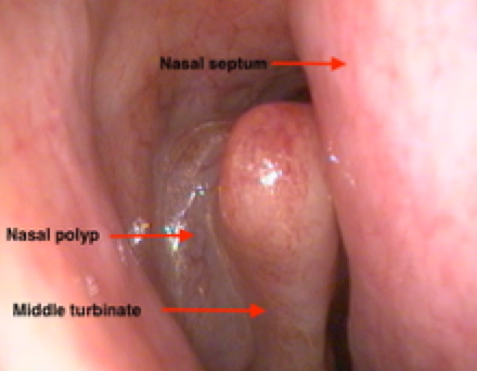 Firgure 6: shows significant nasal polyps can impinge the nasal airway. This is associated with nasal blockage, and reduced sense of smell, and often snoring. Treatment of severe nasal polyps can be curative for snoring in selected patients.
