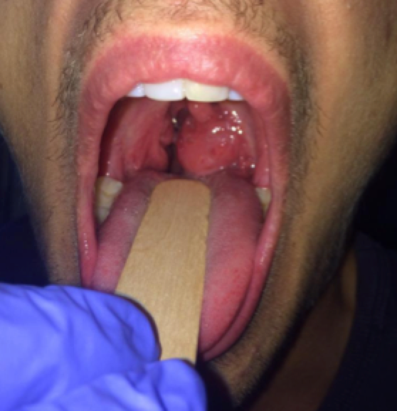 Figure (above): severely infected and enlarged tonsils