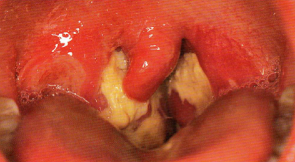 Figure (above): severe tonsillitis in Epstein Barr Virus infection(glandular fever)