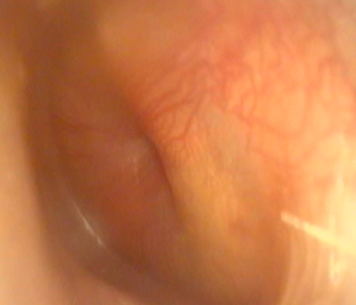 Figure: the red drum of acute otitis media