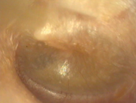 Figure: the golden drum of glue ear