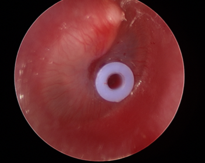 Figure: the appearance of the right eardrum after grommet insertion.