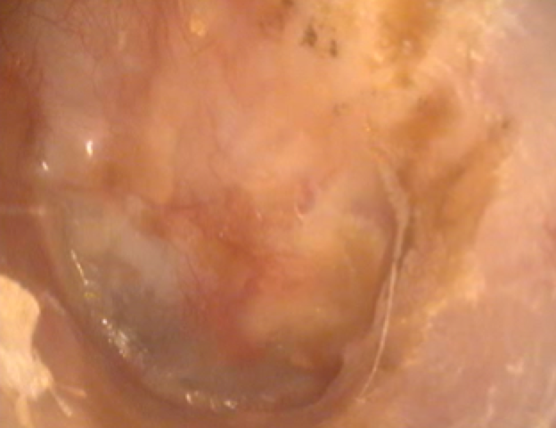 Figure: The same ear as the prior figure after successful surgery by Dr Smith with myringoplasty (repair of the hole in the ear drum), and canalplasty (drilling of the ear canal). The full extent of the eardrum is visible, and is seen to be intact. The ear is dry, waterproof and free of infections.