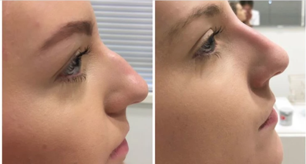 Non+surgical+rhinoplasty+results?format=1000w