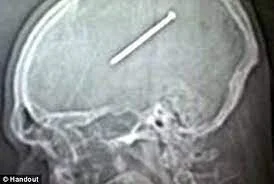 A NAIL IN YOUR BRAIN