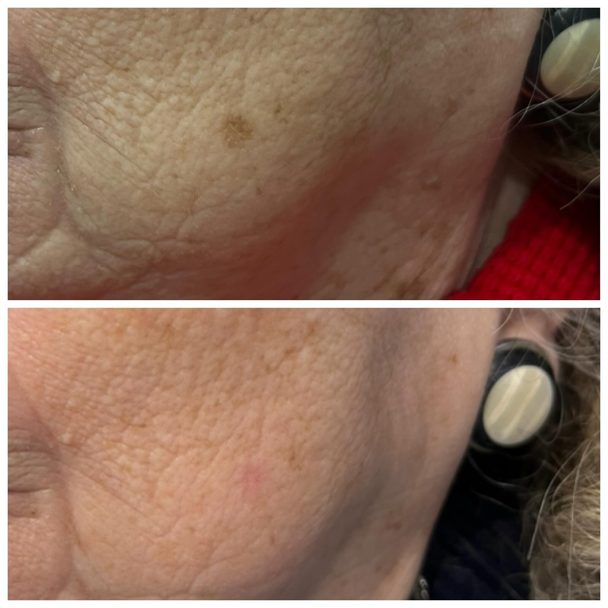 Now you see it - now you don&rsquo;t 
&mdash;&mdash;&mdash;&mdash;&mdash;
Even with the lighting being different on the before and after photos you can clearly see the pigmented area is gone - 2 weeks between photos 
&mdash;&mdash;&mdash;&mdash;&mdas