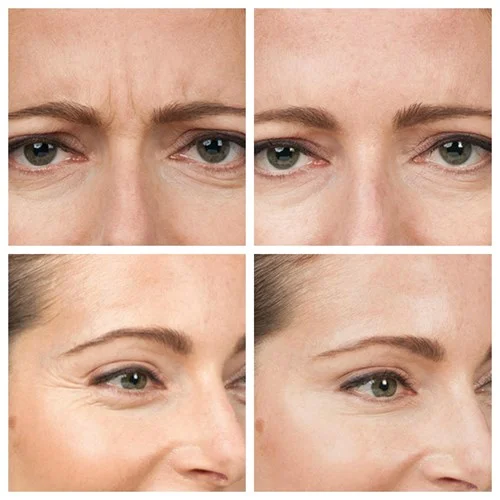 Botox Treatment