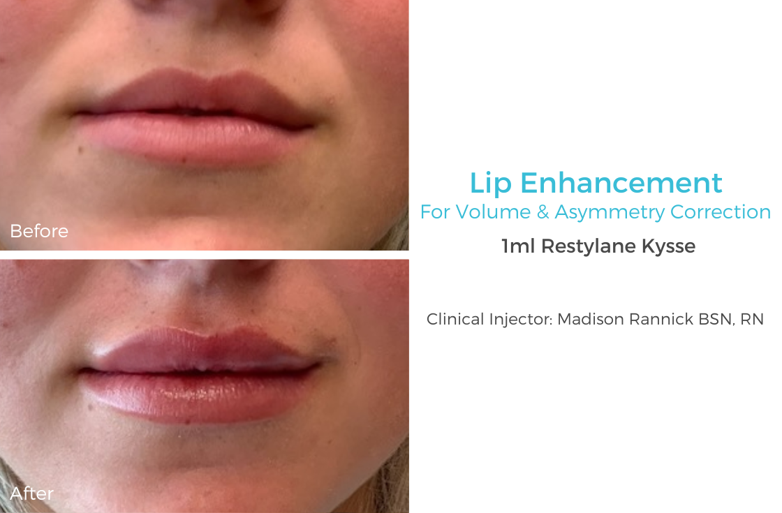 Lip Enhancement 64 11-20-22.png