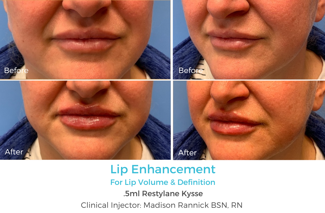 Lip Enhancement 67.png