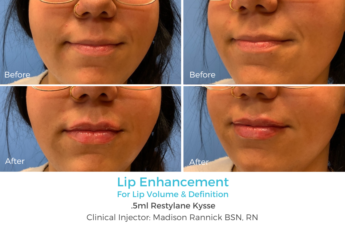 Lip Enhancement 68.png