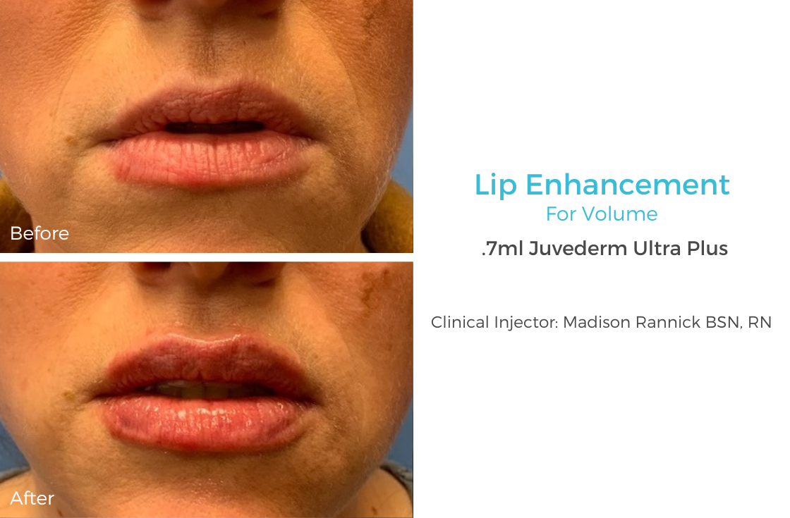 Lip Enhancement 70.png