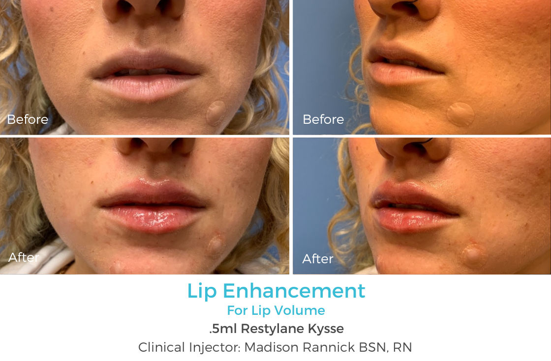 Lip Enhancement 71 .png