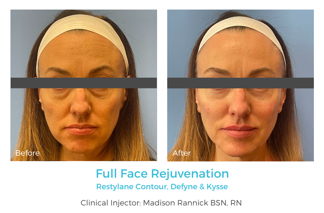 Full Face Rejuvenation 3.png